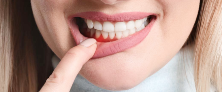 Чем полоскать рот при воспалении десен: действенные средства для полоскания