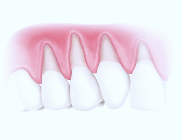 Лечение клиновидного дефекта зуба