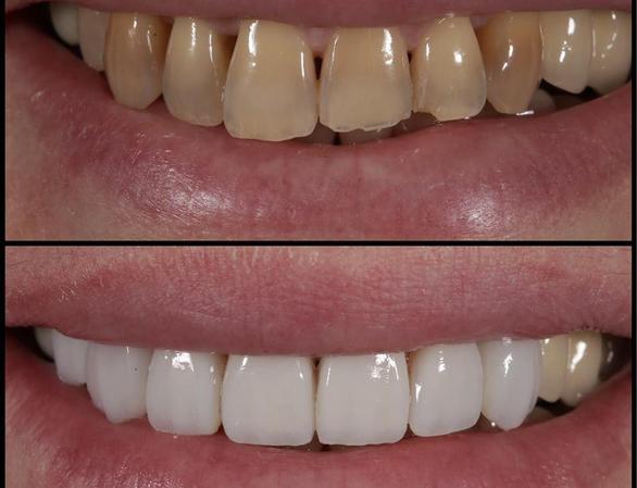 Пример реставрации зубов