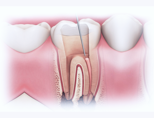 Гранулема зуба: симптомы, методы лечения