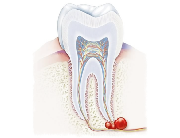 Что такое киста зуба, почему она возникает и как ее вылечить без боли