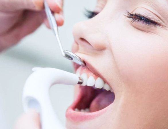 Как восстановить эмаль зубов – можно ли провести восстановление в домашних условиях